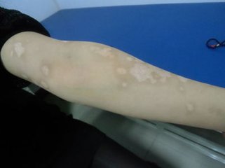 白癜风 白癜风