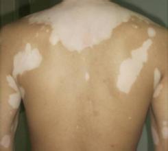 儿童患白癜风的原因是什么 儿童患白癜风的原因是什么.jpg